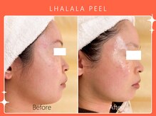 ハノハノ 八代店(HANO HANO)/韓国肌管理ララピール☆