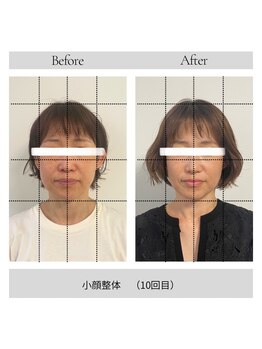 ソルヴィス 根本(soLvis)の写真/どうにもならない長年の食いしばり【ガチガチエラ張り】【老け顔】【顔の左右差】を丁寧にほぐし小顔に！