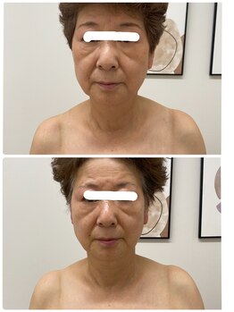 メリア(MeLiA)/小顔1回でエイジングケアも◎