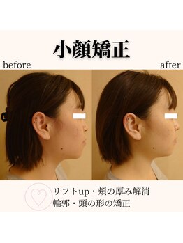 RKY/小顔矯正&頭蓋骨矯正