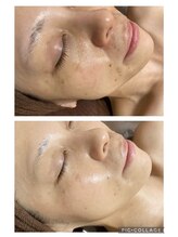 サロンデュヒャーク 志木駅前店(salon du ひゃーく)/陶肌トリートメント症例写真