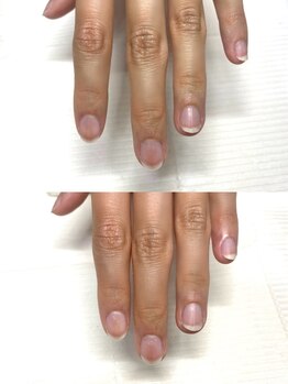 フローリス(Flouriss)の写真/《乾燥/2枚爪/ささくれ/手荒れ》も徹底ケア♪健やかな自爪・手肌に*☆塗るだけ巻き爪フットケア導入*
