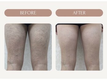 バーグトータルビューティー(bague total beauty)/足脱毛