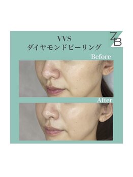 ザラハビューティー(ZARAHA Beauty)/VVSダイヤモンドピーリング