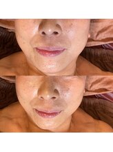 ララルアナ(Lara luana)/小顔リフトケア