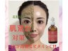 最強【高濃度ビタミンCニキビケア♪】REVIハーブピーリング13,200円→8,800円