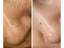 サイ(Sai)/before⇒after