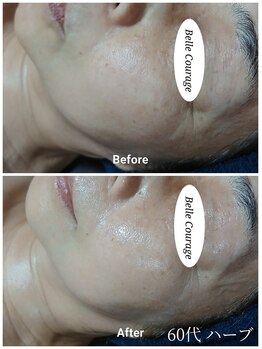 ベルクラージュ(Belle Courage)/60代　毛穴・リフトアップ