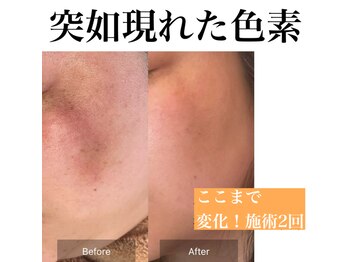 サロンツキ(salon tuki)/【最新光機器症例】ブログへ