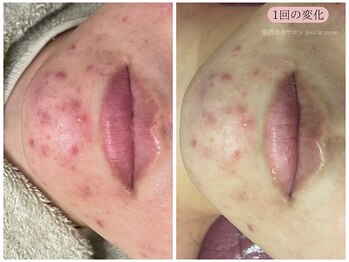 レスイズモア 恵比寿(less is more.)/【１回の変化】ニキビケア