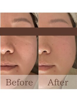 凪眠/小顔リンパフェイシャルの効果18