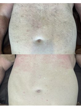 アカラ 読谷店(AKALA)/上半身脱毛