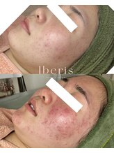 イベリス(Iberis)/ハーブピーリング/敏感肌