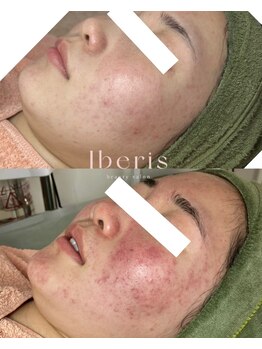 イベリス(Iberis)/ハーブピーリング/敏感肌