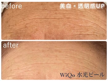 ルアナ(Luana)/【WiQoワイコ水光ピーリング】