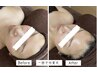 【肌管理と小顔管理】小顔調整＋ララピール＋お顔EMS　20,800→17,500