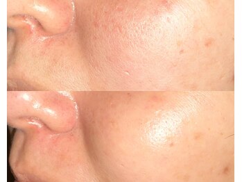 ル シーニュ/プラズマ×炭酸パック