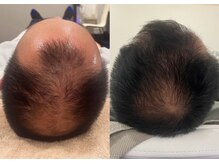 ビーティークリニカル 新宿三丁目(BT clinical)/育毛促進フルコース