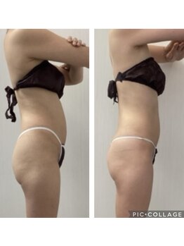 BBC 田園調布/上半身（下半身）ダイエット