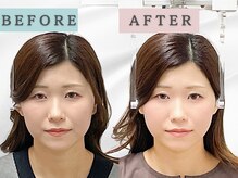 エルシンメトリー矯正院(ailesシンメトリー矯正院)/before＆after　ailes式小顔矯正
