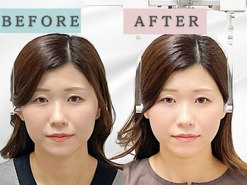 エルシンメトリー矯正院(ailesシンメトリー矯正院)/before＆after　ailes式小顔矯正