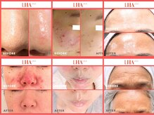 ランソ ビューティー 成田(RUNSO Beauty)の雰囲気（ララピールで本気の肌質改善。重ねる毎に自分史上最高の肌に。）