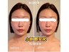 荻窪☆【Vライン小顏】肌質毛穴・むくみ・たるみ改善♪ 90分 1回で変化実感☆