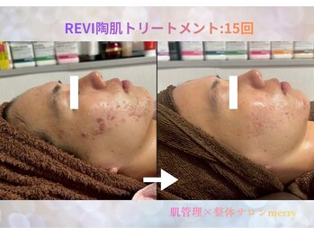 メリー 大和西大寺店(merry)/ハーブピーリングBefore after★