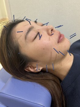 まえかわ鍼灸整骨院の写真/お顔のたるみ・むくみをケアする美容鍼◎首肩コリに直接届く鍼灸施術など豊富なメニューが魅力♪