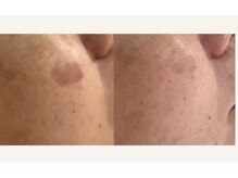 グロウスキン(GROW SKIN)/★変化を実感！純粋レチノール