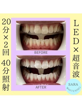 ココティ ホワイトニング(Cocotii)/ビフォーアフター