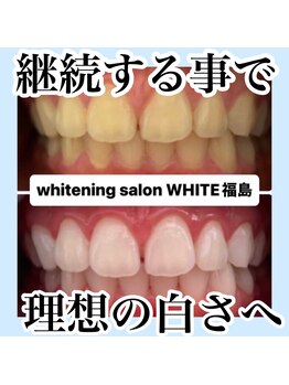 ホワイトニングサロン ホワイト(WHITE)/継続する事で理想の歯に