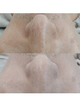 ヴェルシック(Belchic)/お悩みの方も多い鼻の毛穴