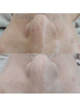 ヴェルシック(Belchic)/お悩みの方も多い鼻の毛穴