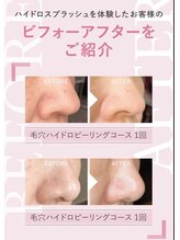 アムレット(Amourette)/ハイドロスプラッシュ毛穴洗浄