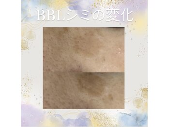 ホッコリ 府中店(HOKKORI)/BBLフェイシャル～頑固なシミに