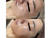 ウィズティ(with.T)/シフォンピーリング