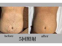 アンド エヌ(&n)/◆全身脱毛◆