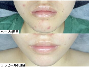 アンドミー 神戸元町店(&me)/ララピール【艶肌/肌質改善】