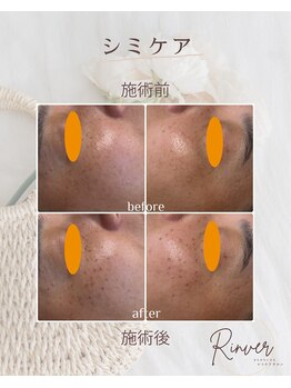 リンバー(Rinver)/シミケアBefore・After