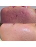 メンズニキビ、肌の凹凸、肌を生まれ変わらせる、たまご肌ピーリング
