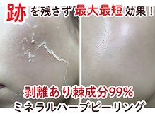 ビースキン 広島(BE:SKIN)/全身脱毛/フェイシャル/VIO