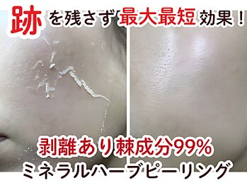 ビースキン 広島(BE:SKIN)/全身脱毛/フェイシャル/VIO