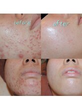 ビューティーサロンレモン(Lemon)/芸能人ピーリング