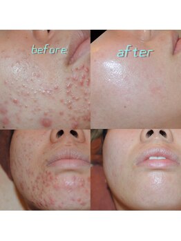 ビューティーサロンレモン(Lemon)/芸能人ピーリング