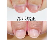 ネイルアンドアイラッシュ シシュ 高槻店(nail&eyelash SyiSyu)の雰囲気（深爪矯正¥7700→6600）