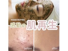 オッティモ(ottimo)の雰囲気（1回で実感！ハーブリプロ/皮が向ける/ダウンタイムあり背中も◎）
