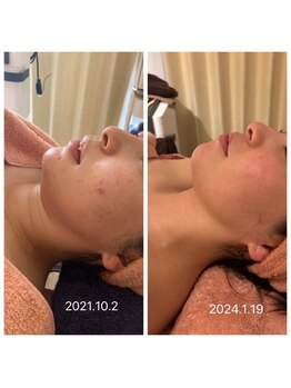 アティレ オオサカ(Attirer Osaka)/リフトアップ/小顔/ハリ/ツヤ