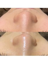 ナチュウル(Natulu)/毛穴洗浄一回でこの効果♪