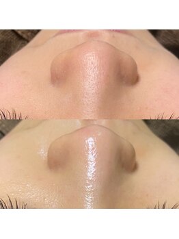 ナチュウル(Natulu)/毛穴洗浄一回でこの効果♪